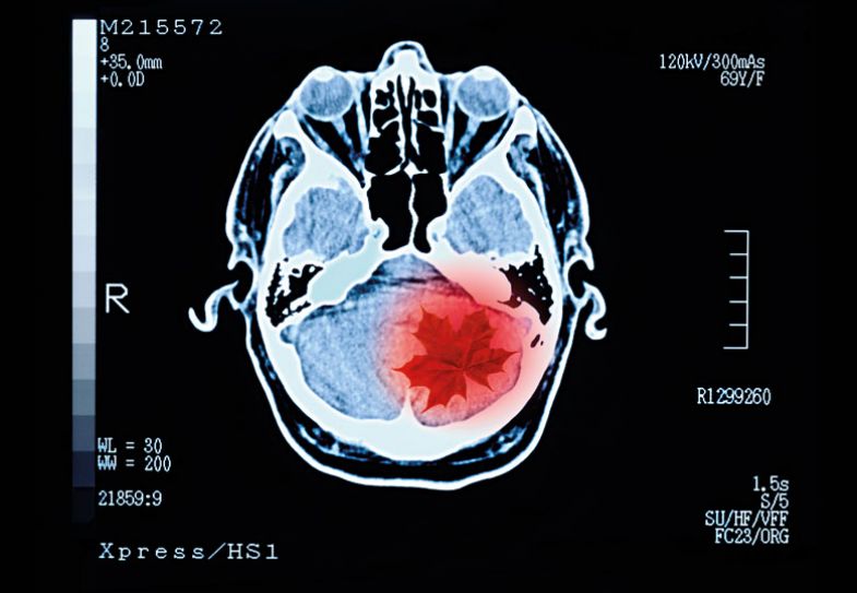 Montage of a brain scan with a red leaf inside