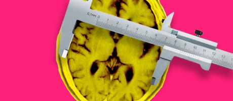 MRI of the brain of a patient affected by Alzheimer’s disease axial section, with calipers measuring. To illustrate how Aria can prove its worth in brain disorders and other projects. MRI of the brain of a patient affected by Alzheimer’s disease axial section, with calipers measuring. To illustrate how Aria can prove its worth in brain disorders and other projects.
