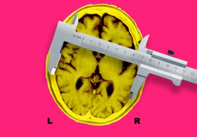 MRI of the brain of a patient affected by Alzheimer’s disease axial section, with calipers measuring. To illustrate how Aria can prove its worth in brain disorders and other projects.