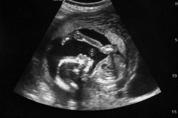 An ultrasound image of a foetus An ultrasound image of a foetus